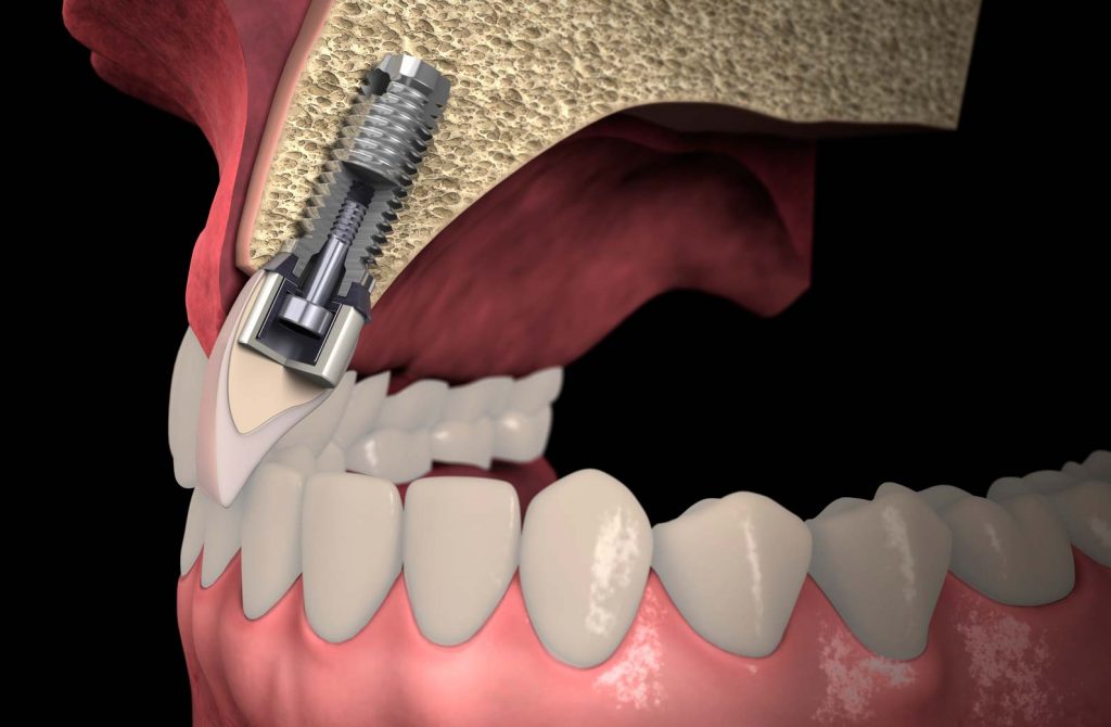 Cirugía Oral en Zaragoza Clínica Dental MAIP