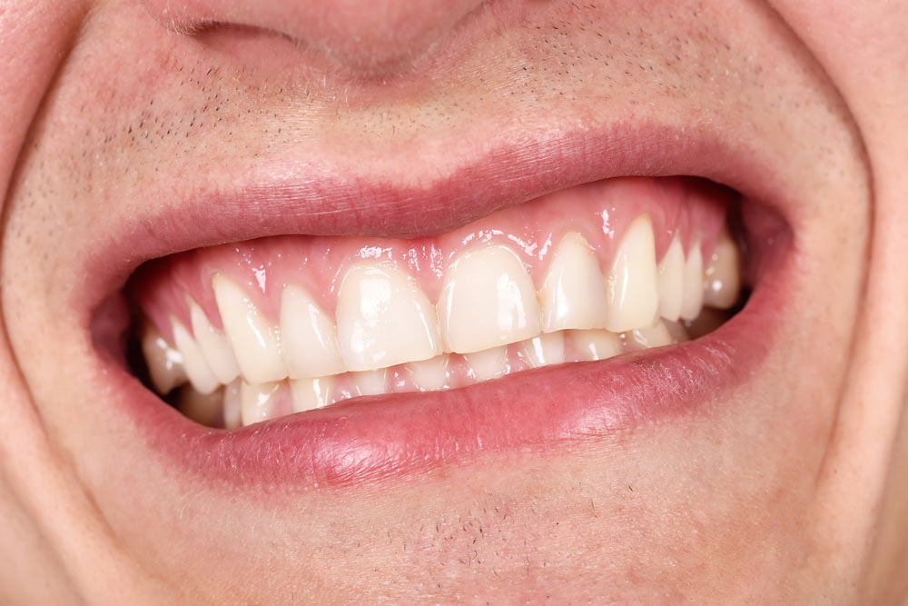 ¿Por qué apretamos los dientes?