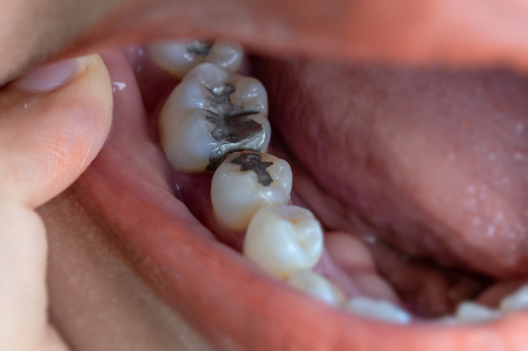 ¿Se aclaran los empastes con el blanqueamiento dental? 