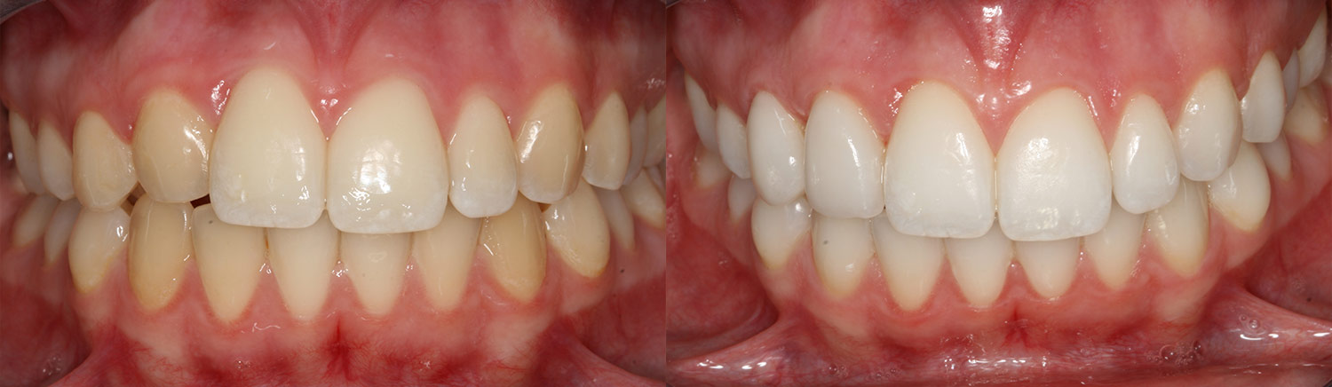 ¿Se aclaran los empastes con el blanqueamiento dental? 