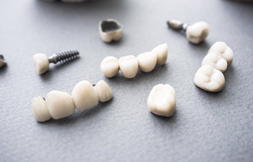 ¿Cómo se sujetan los dientes sobre los implantes?