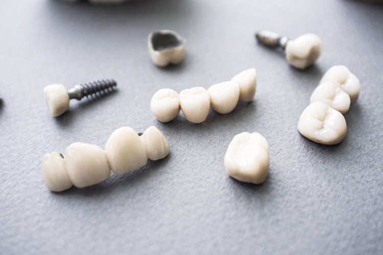 ¿Cómo se sujetan los dientes sobre los implantes?