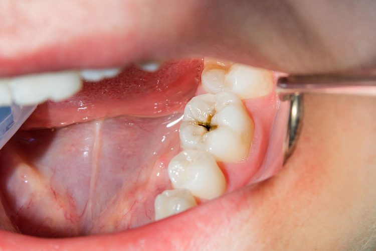Cómo evitar tener caries