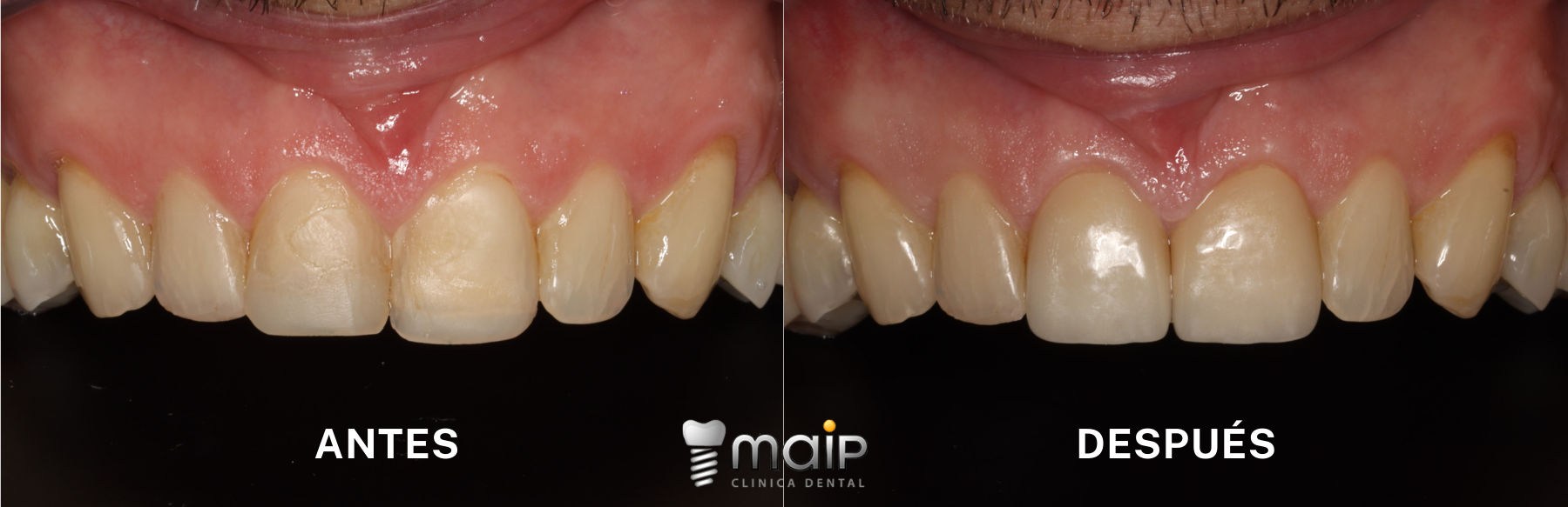 Antes y después caso clínico carillas dentales