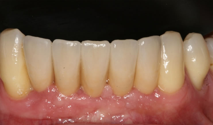 Implantes dentales varios dientes - después