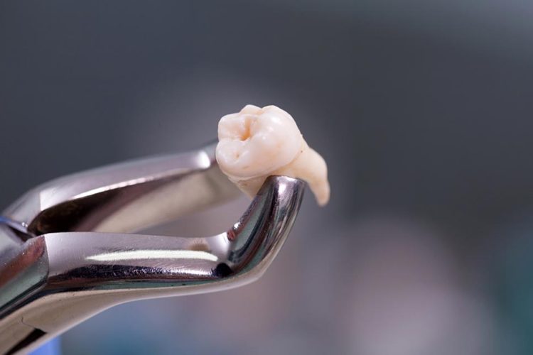 ¿Qué hacer después de una extracción dental?