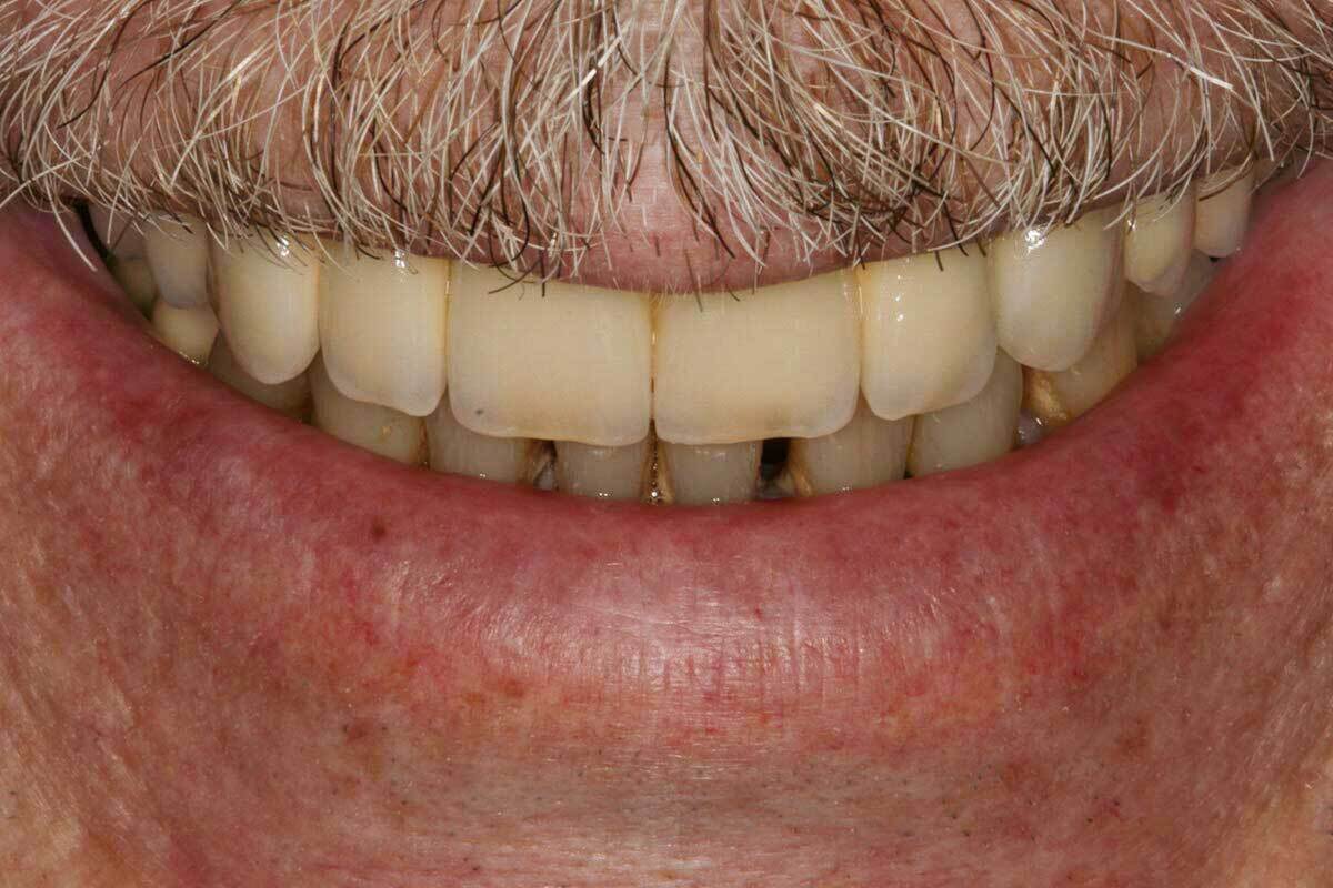 Implantes dentales para toda la boca