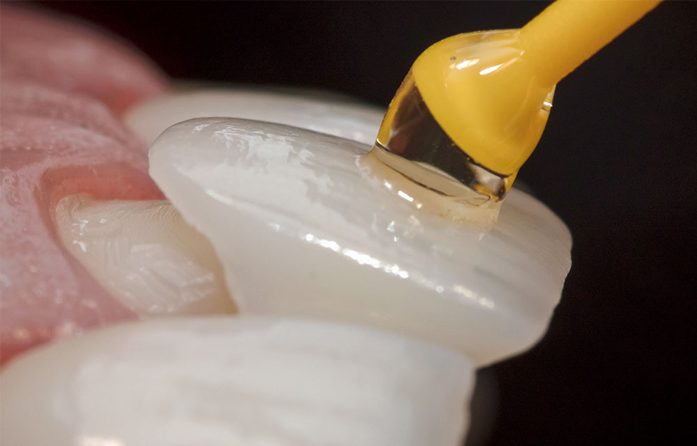 ¿Cuánto se desgasta un diente para hacer una carilla?