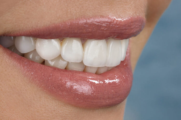 Cuidados para tus carillas dentales
