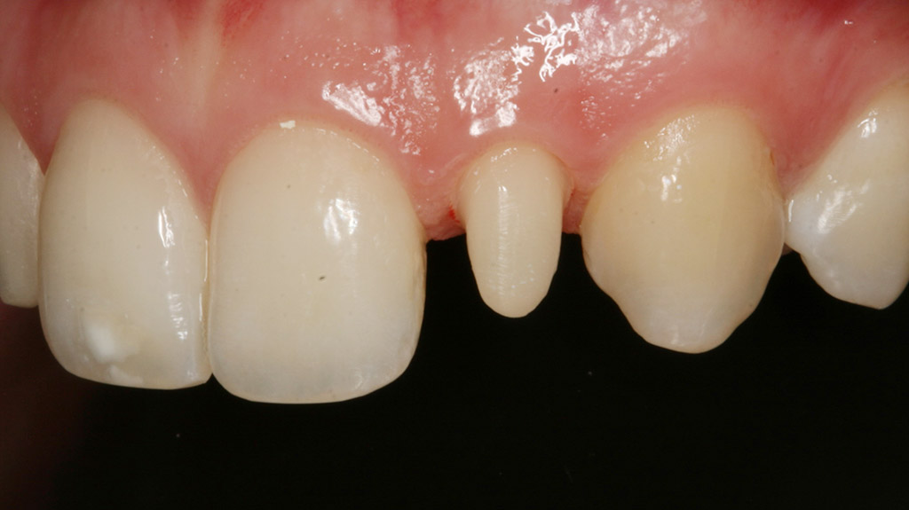 Qué son las carillas dentales? ¿En qué consiste el tratamiento?