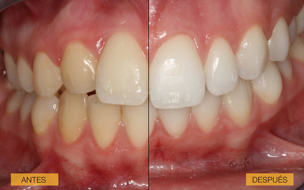 Antes y después de un caso clínico de blanqueamiento dental