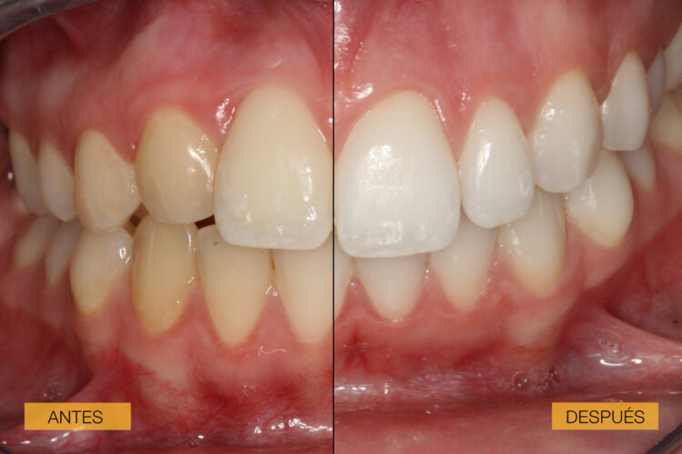 Antes y después de un caso clínico de blanqueamiento dental