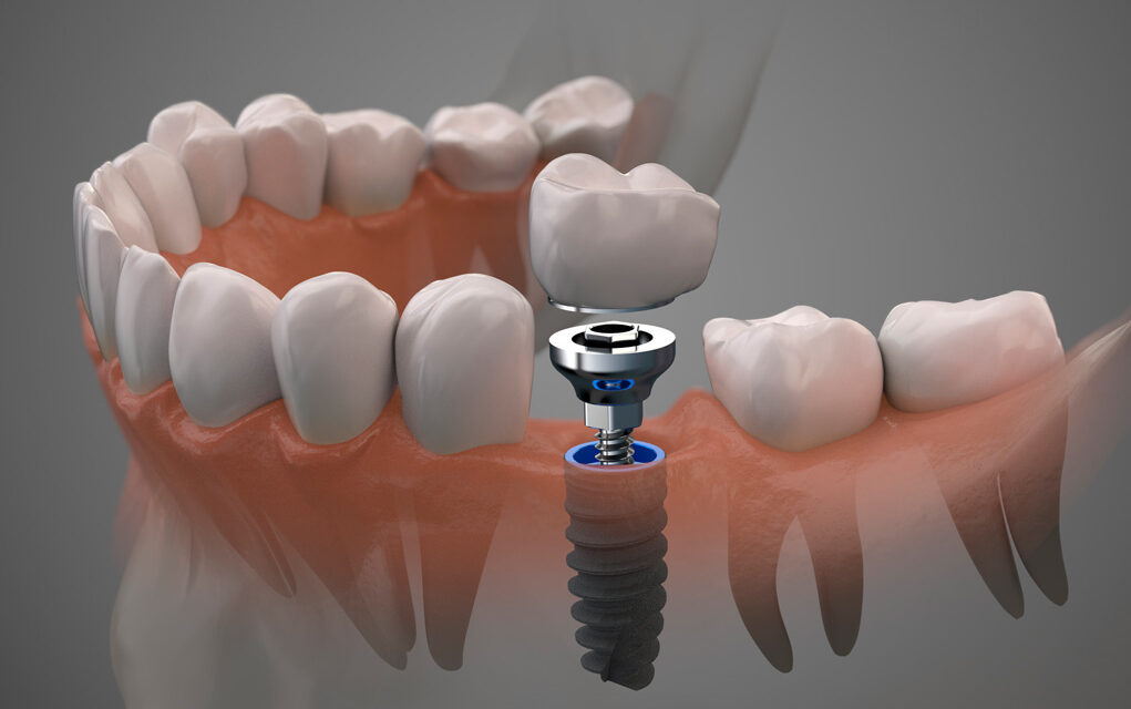Imagen ficticia de una boca con un implante dental