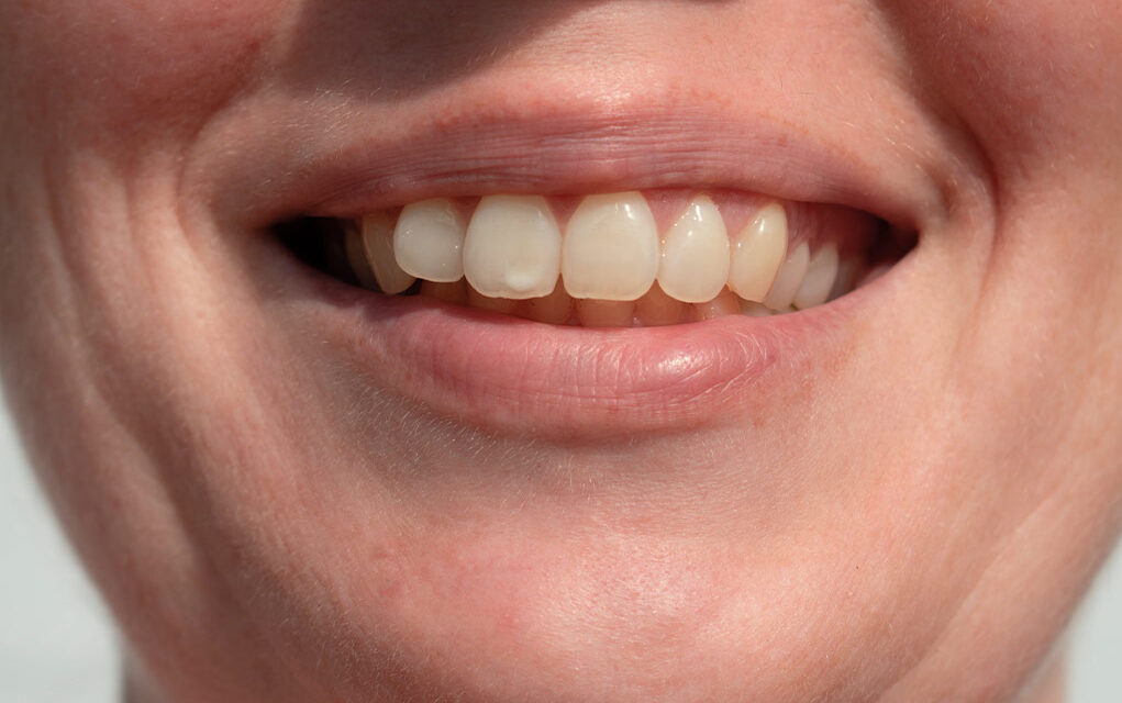 mancha blanca diente