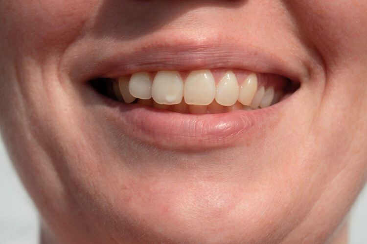 mancha blanca diente