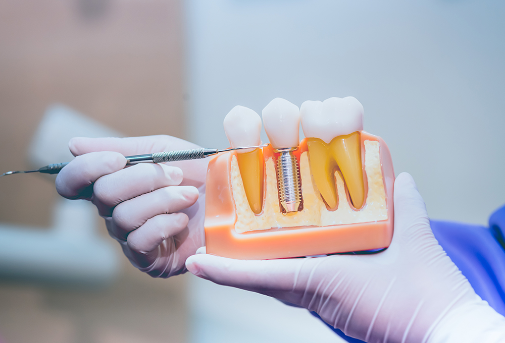 ¿Por qué se mueve un implante dental?