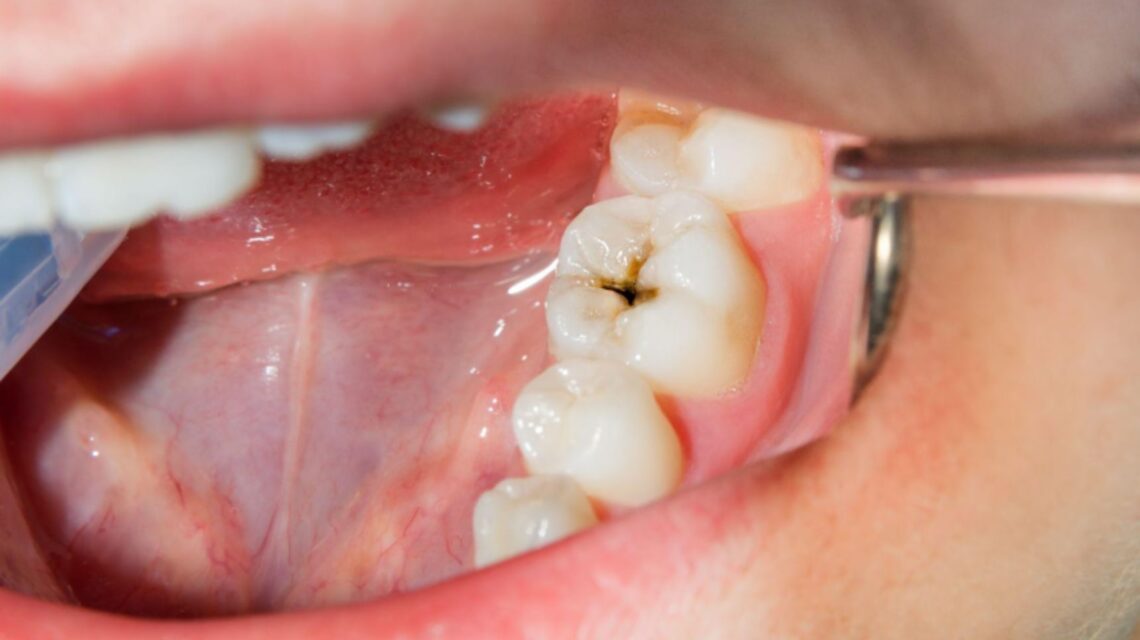 niño con una caries en muelas de leche