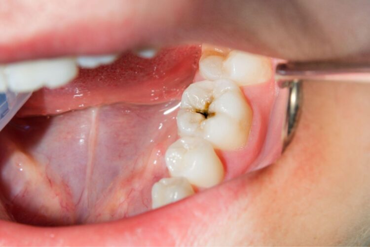 niño con una caries en muelas de leche