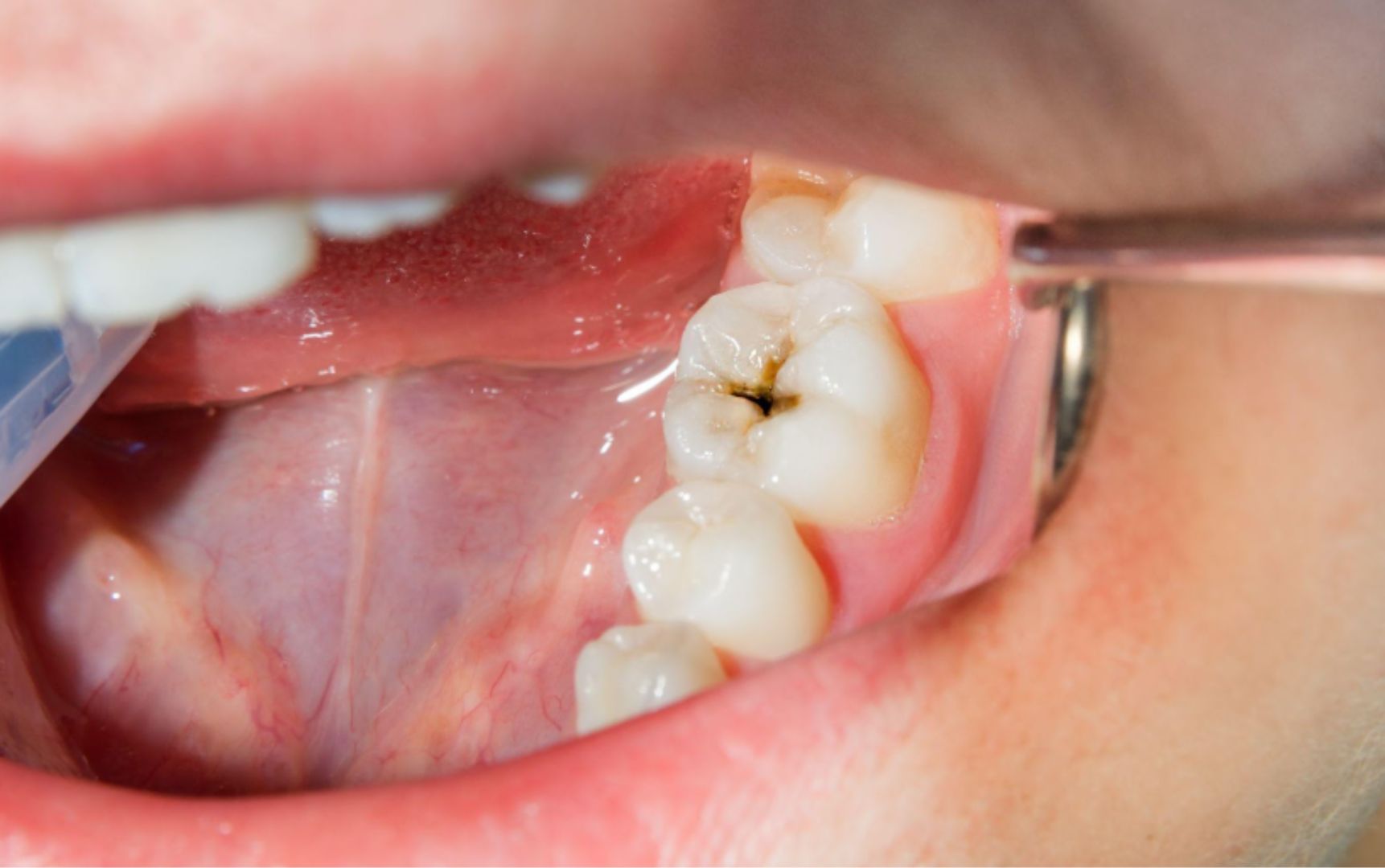 ¿Qué hacer si hay caries en las muelas de leche?