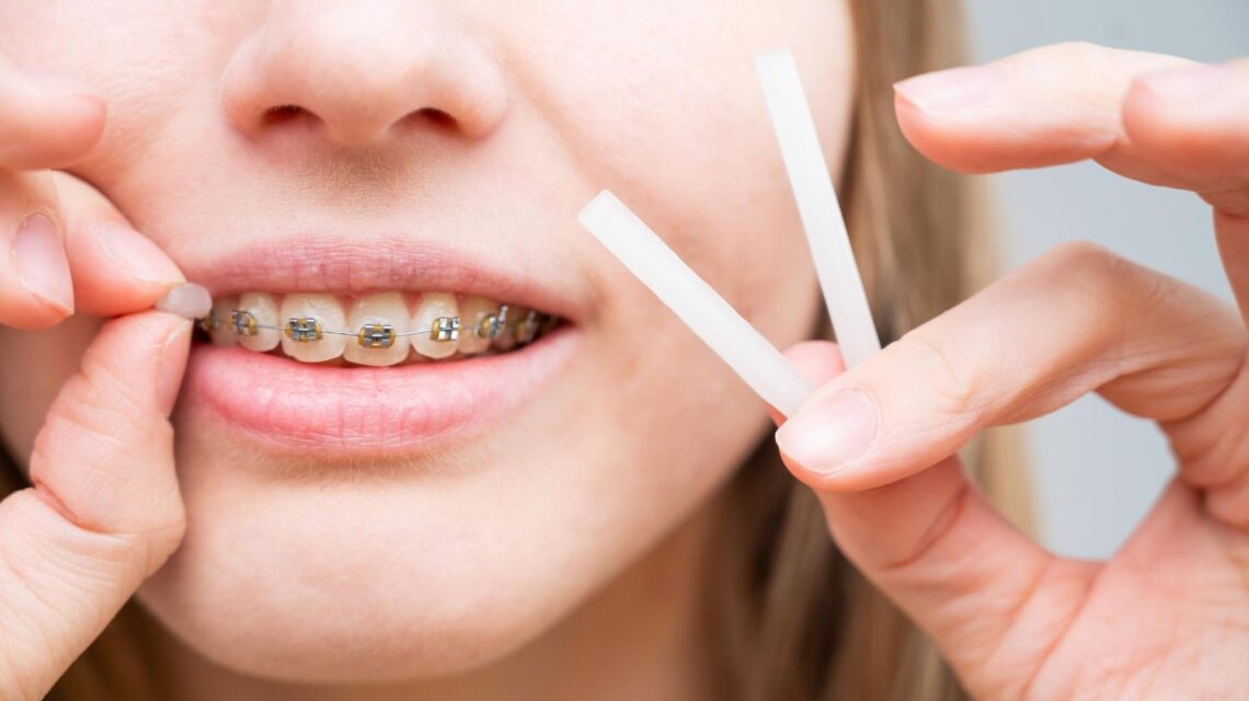 chica poniéndose cera en los brackets