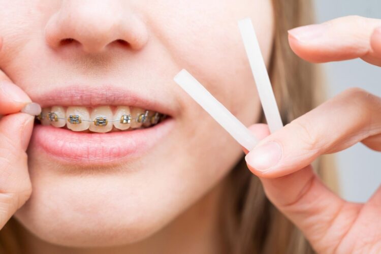 chica poniéndose cera en los brackets