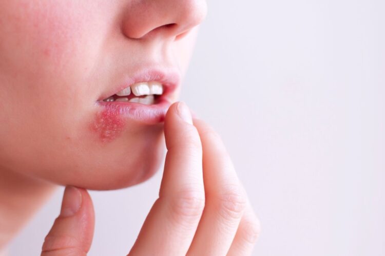 boca con sarpullido por mononucleosis