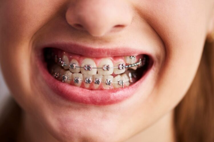 llevar-ortodoncia-con-enfermedad-periodontal