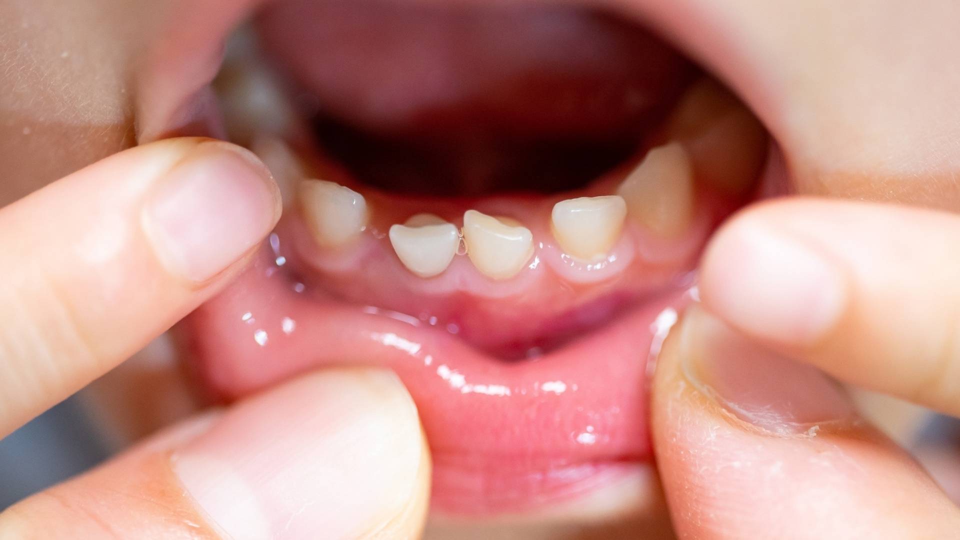 ¿Es normal que los dientes de leche salgan torcidos?