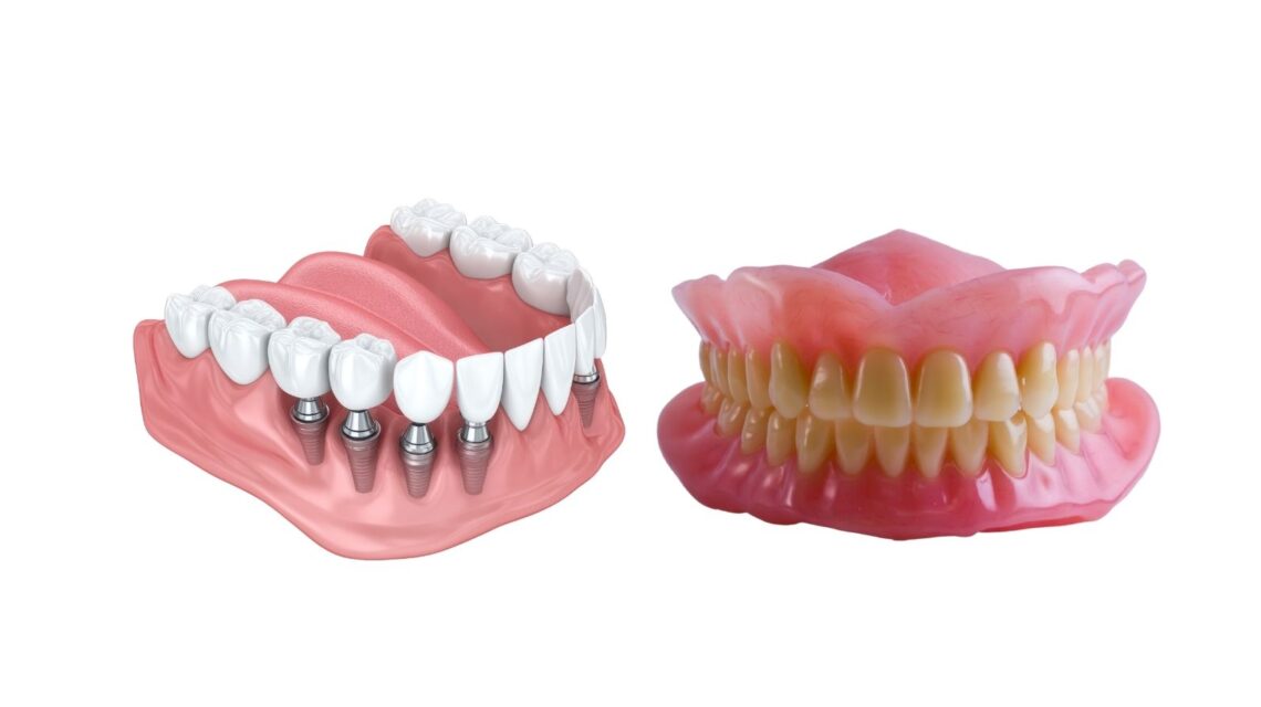 imagen de implantes y prótesis removible