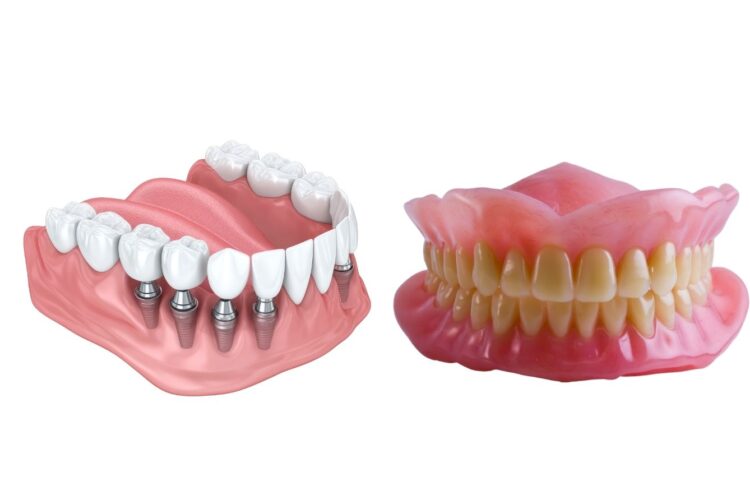 imagen de implantes y prótesis removible