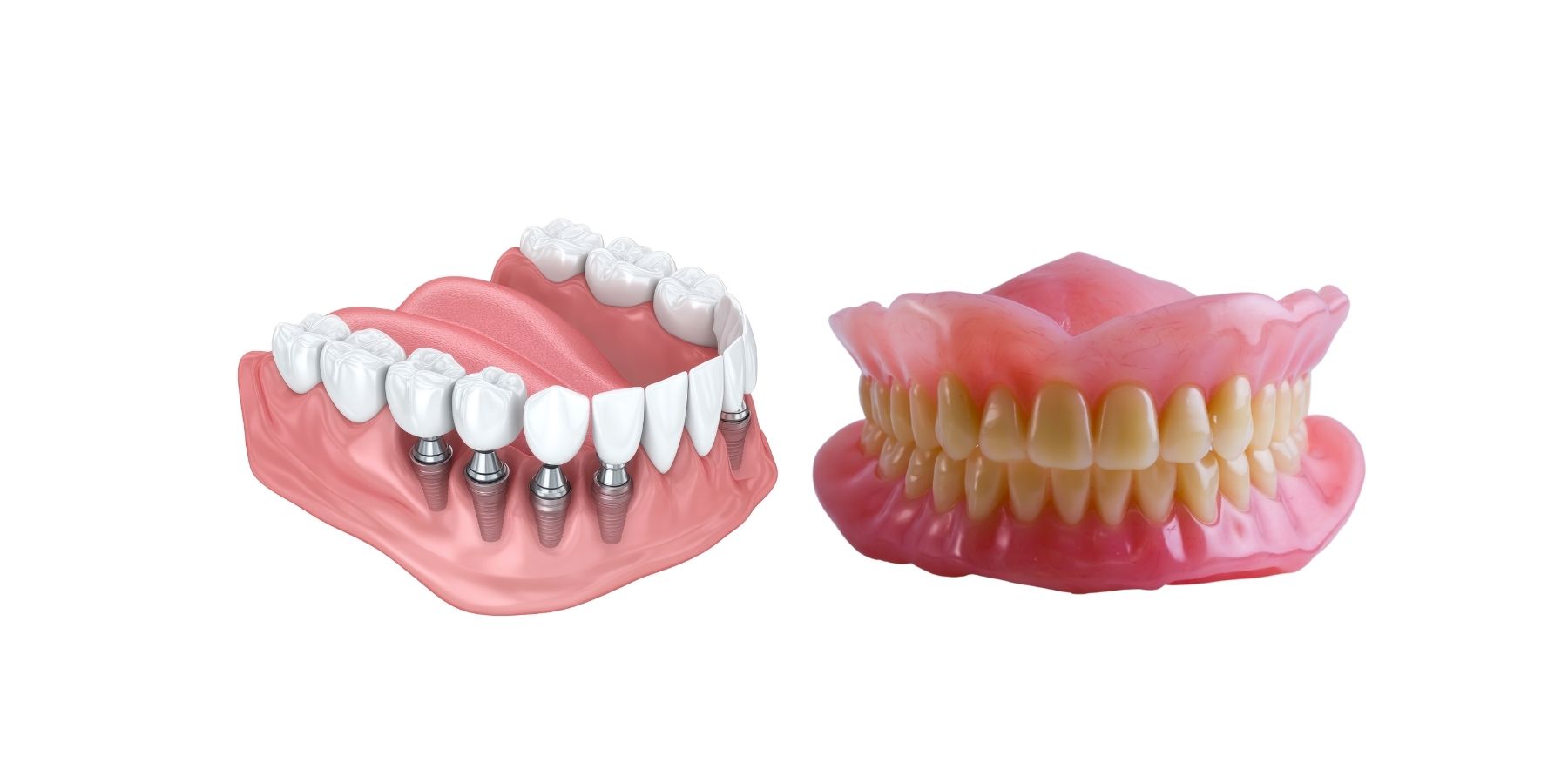 Diferencias entre implantes y prótesis removibles