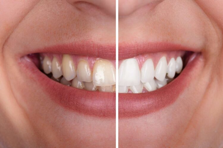 comparación de sonrisa con machas y sonrisa blanca