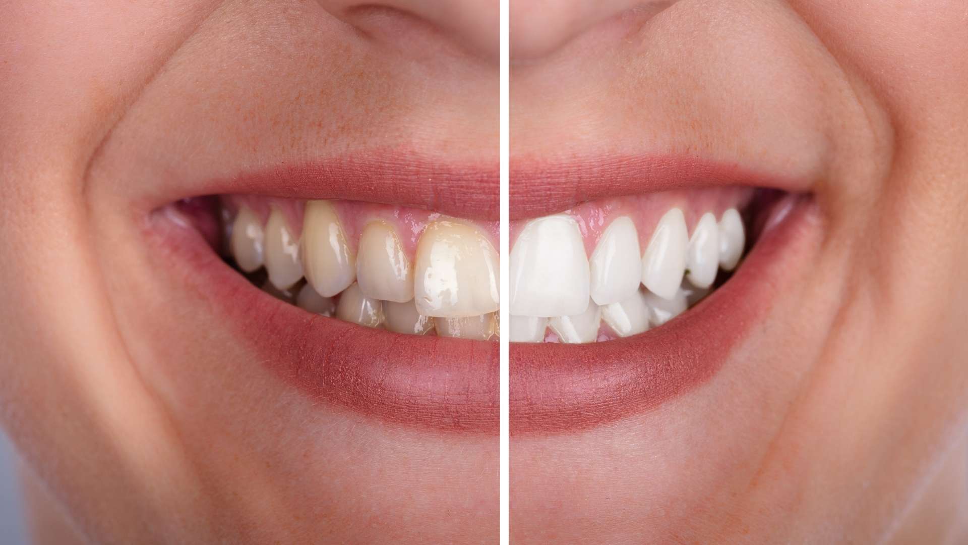 Tipos de manchas dentales y cómo eliminarlas